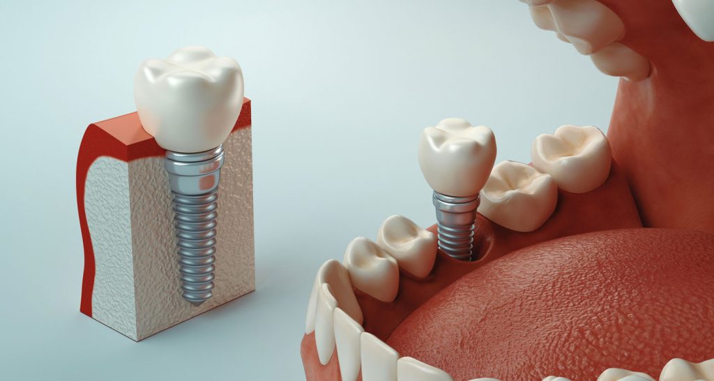 Dental-care-dental-implant
